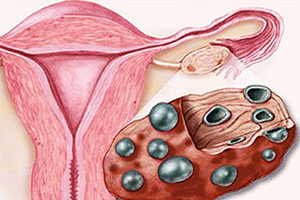  Причины синдрома поликистозных яичников (СПКЯ)