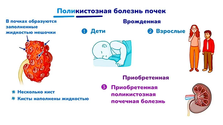 Поликистозная болезнь почек