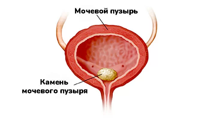 Мочекаменная болезнь