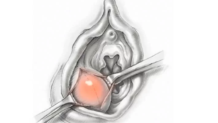 Вскрытие абсцесса бартолиновой железы