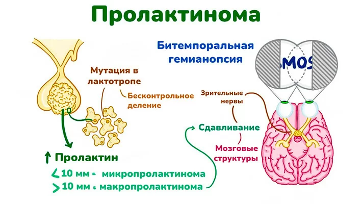 Классификация пролактиномы