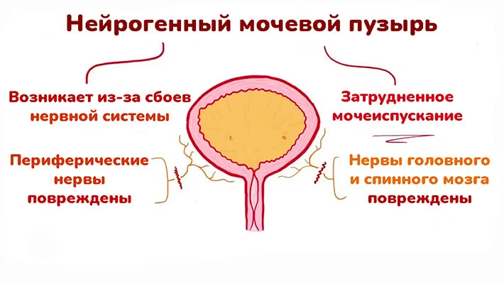 Нейрогенная дисфункция мочевого пузыря у детей причины симптомы и лечение.