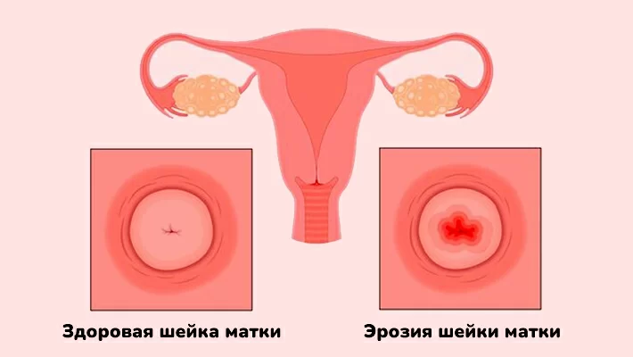 Эрозия шейки матки