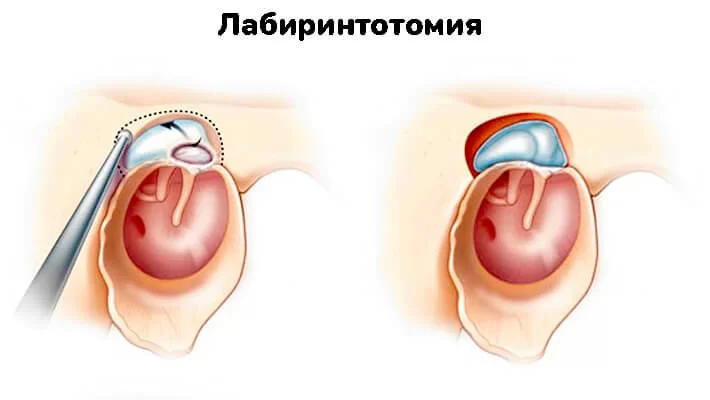 Лабиринтотомия при холестеатоме