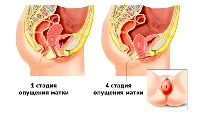 Опущение влагалища