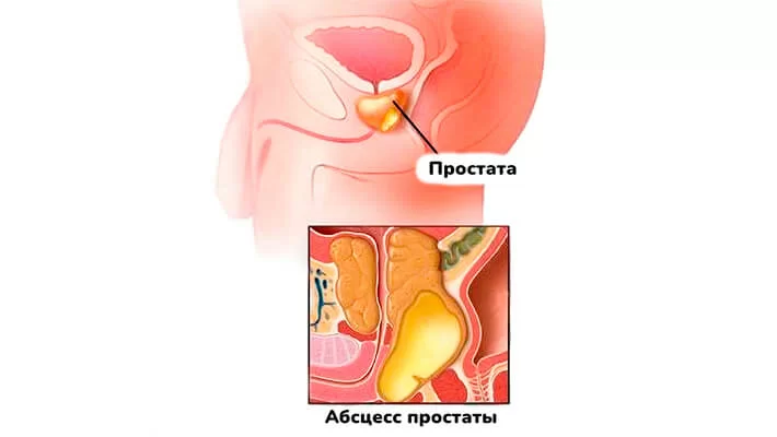 Абсцесс предстательной железы