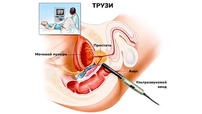 Как делают УЗИ простаты у мужчин
