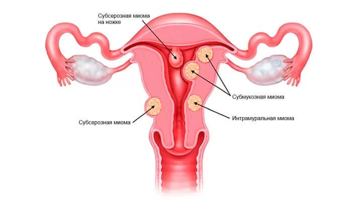 Лечение миомы матки