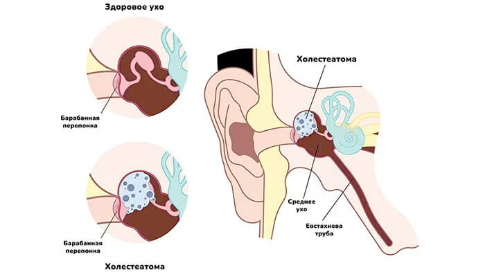 Холестеатома