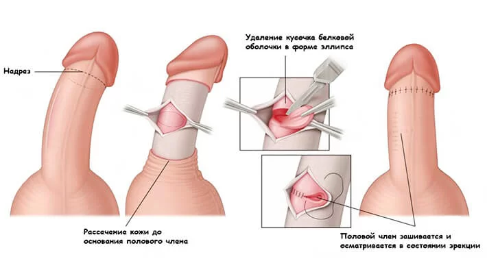 Классическая операция Несбита