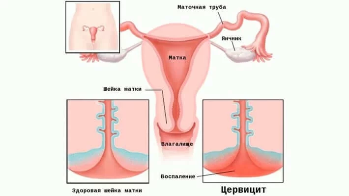 Лечение цервицита