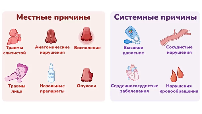 Причины носового кровотечения