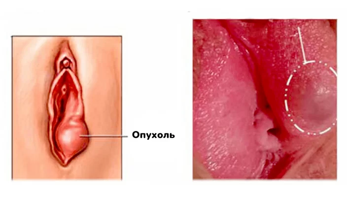 Опухание половых губ