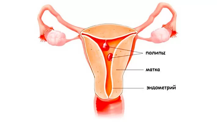 Полипы эндометрия