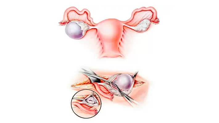 Операция при параовариальной кисте