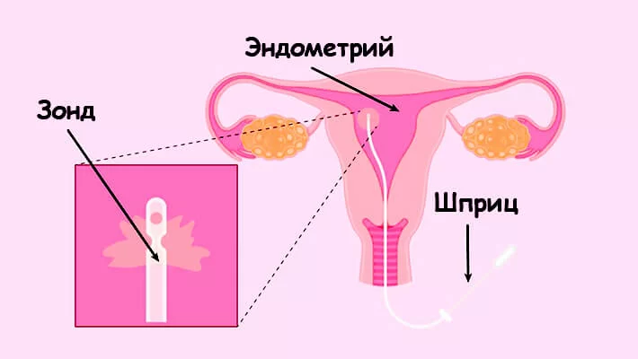 Аспирационная биопсия эндометрия