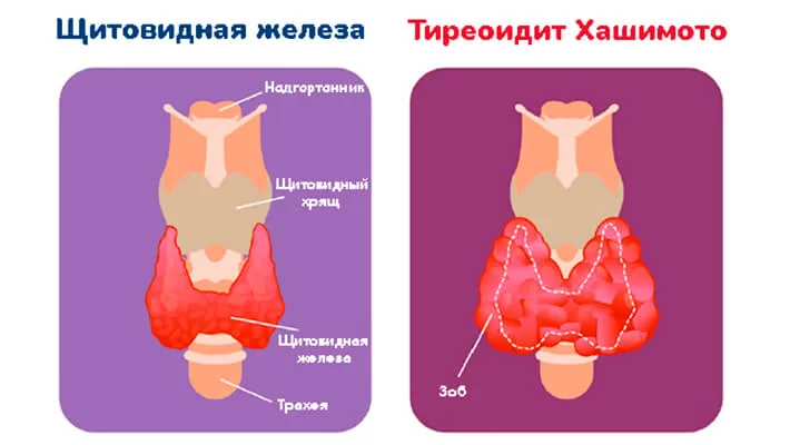 Тиреоидит Хашимото