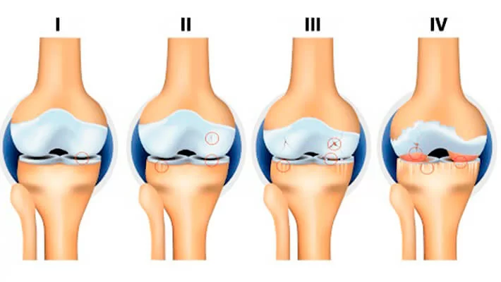 Стадии остеоартроза