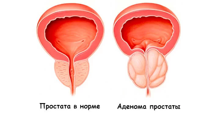 Аденома простаты