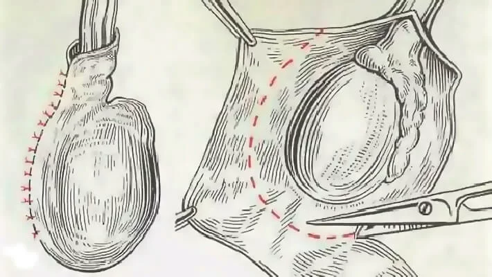 Операция при гидроцеле