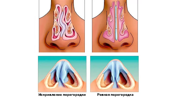 Изменение формы носа при искривлении перегородки