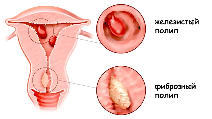 Виды полипов в матке