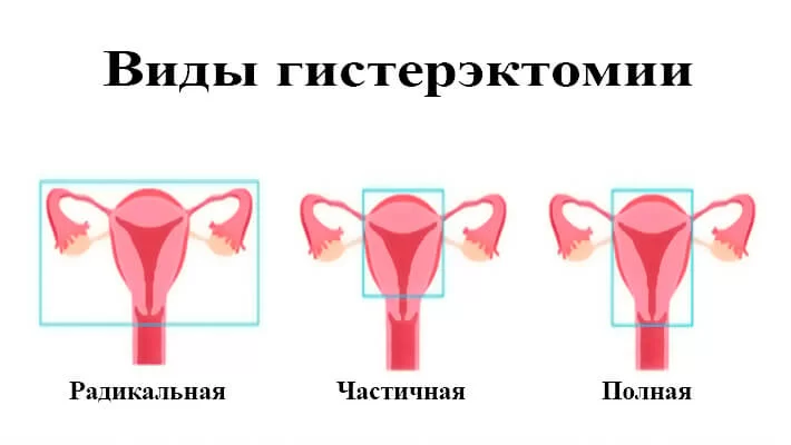 Виды гитерэктомии