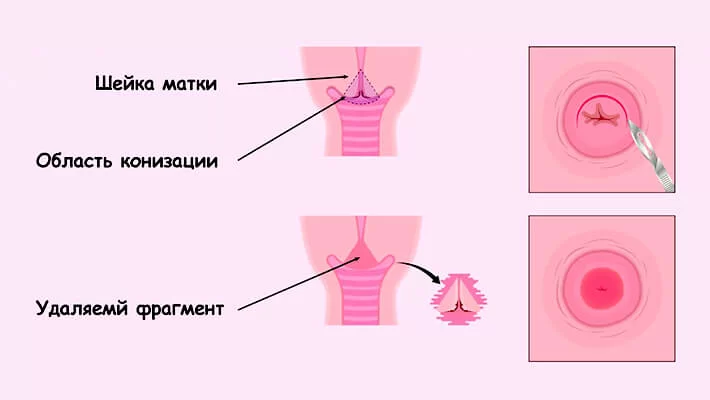Конизация шейки матки
