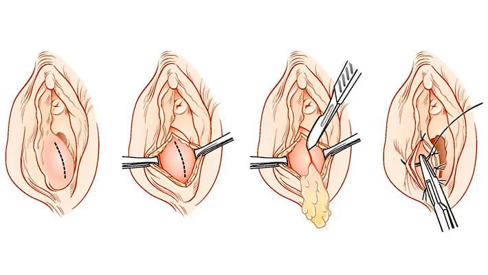 Хирургическое лечение бартолинита