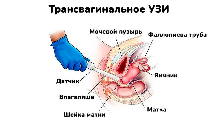 Трансвагинальное УЗИ