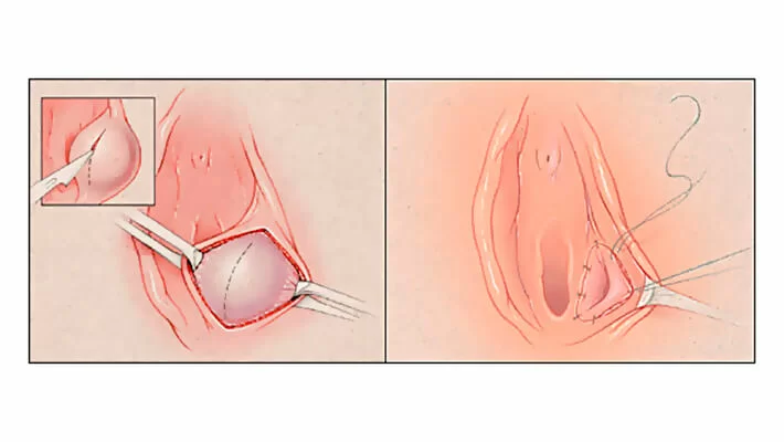 Вскрытие бартолиновой железы