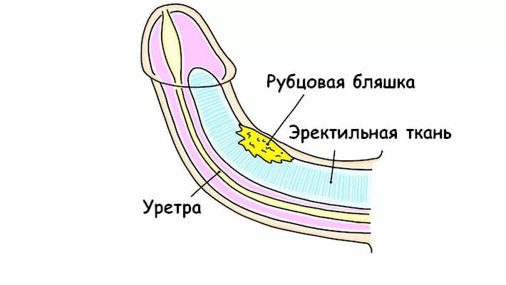 Искривление полового члена