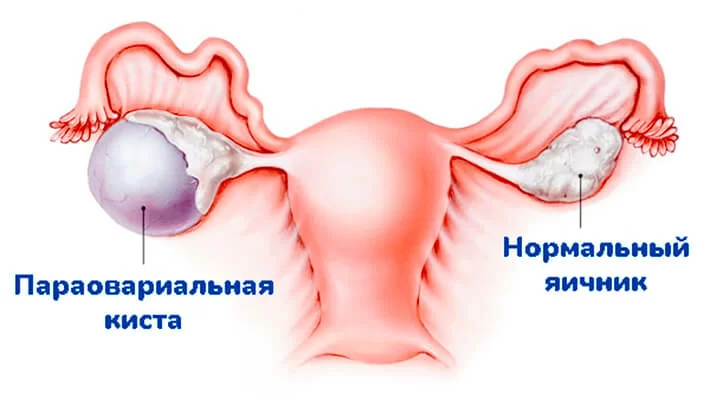 Параовариальная киста