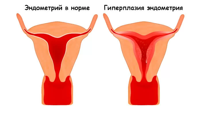 Гиперплазия эндометрия