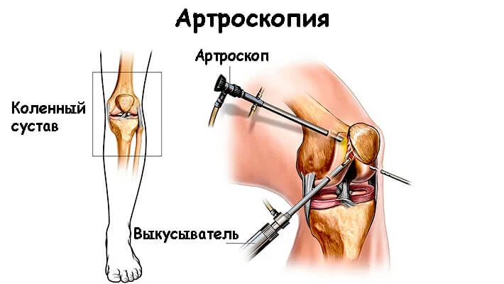 Артроскопия при остеоартрозе