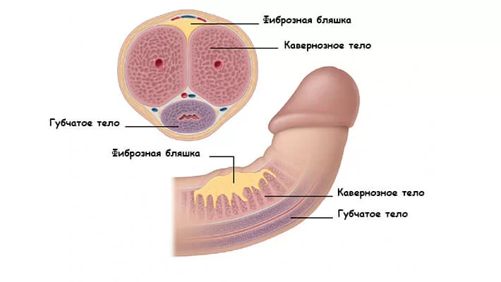 Болезнь Пейрони