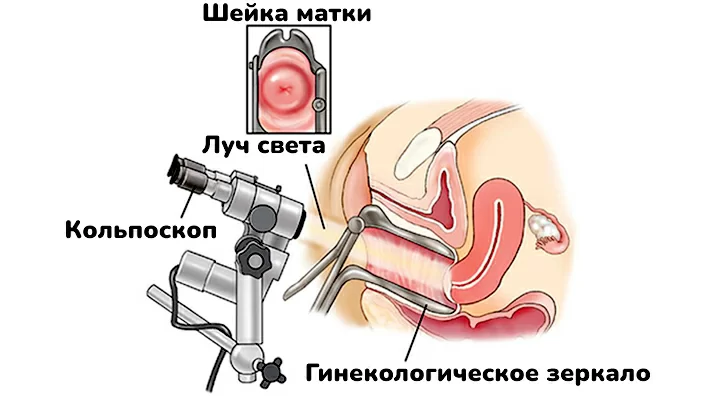 Все о кольпоскопии