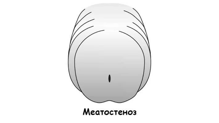 Меатостеноз