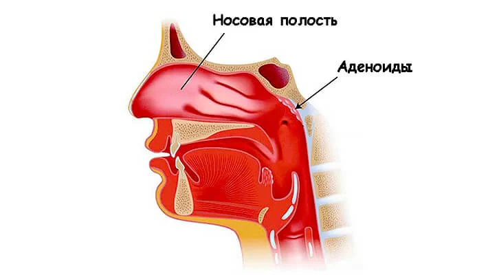 Аденоиды