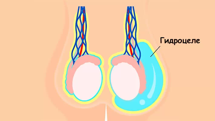 Одностороннее гидроцеле