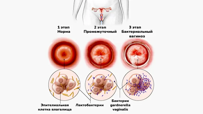 Причины бактериального вагиноза