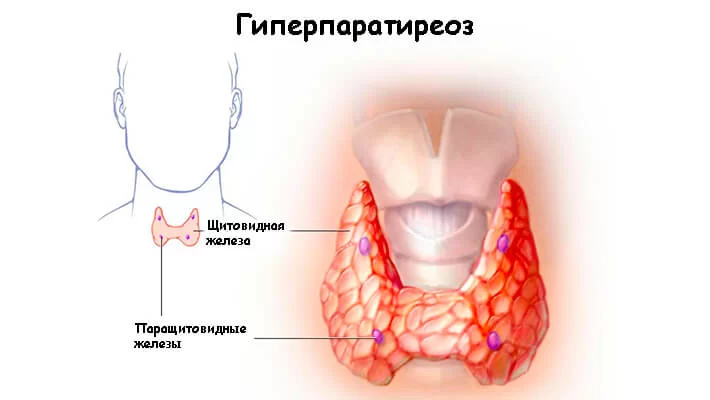 Гиперпаратиреоз