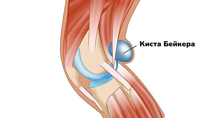 Киста Бейкера