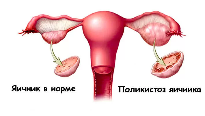 Поликистоз яичников