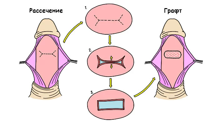 Пластика белочной оболочки (графтинг)