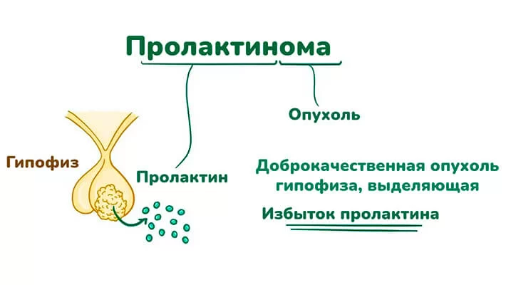 Пролактинома