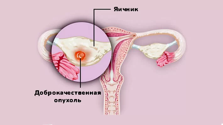 Доброкачественные опухоли яичников