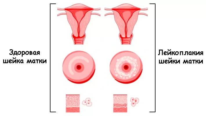 Лейкоплакия шейки матки