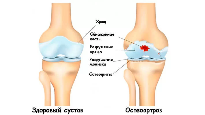 Остеоартроз