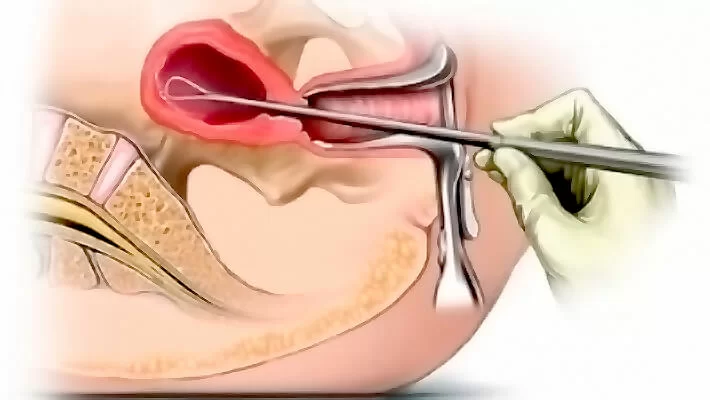 Как проходит хирургический аборт